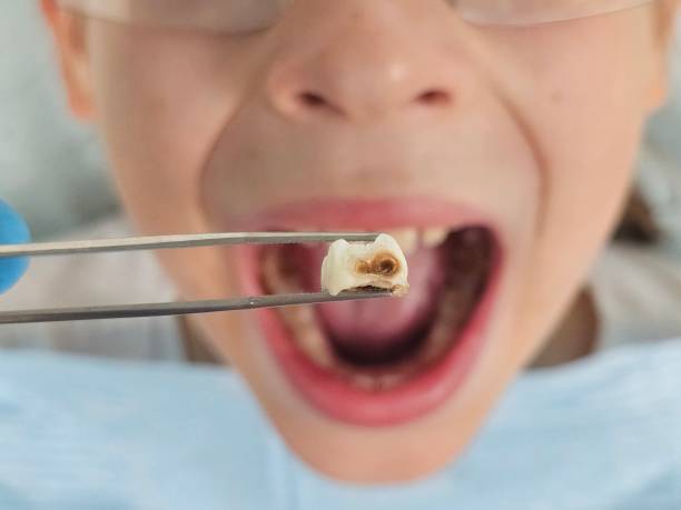 Best Knocked-Out Tooth (Avulsed Tooth) Treatment in Montclair, VA