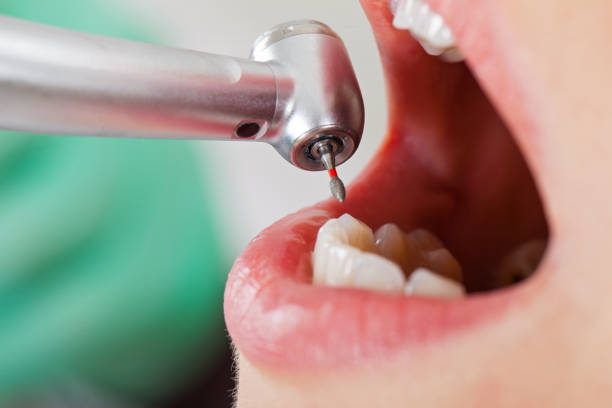 Best Emergency Wisdom Tooth Extraction in Montclair, VA